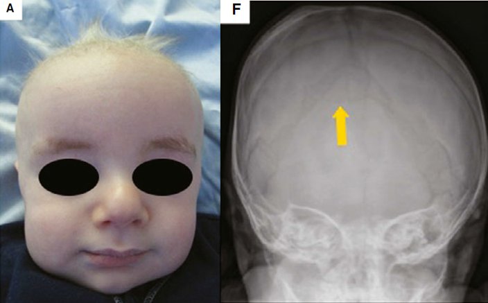 Wouter Karst On Twitter Droms Reports 5 Month Old Boy With
