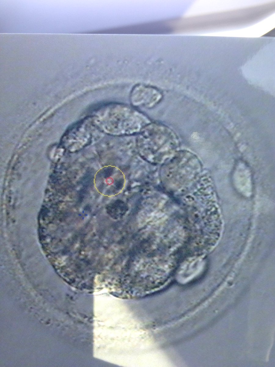 AwkwardInSTL's tweet photo. Embryo thawed great. Now for the two week wait! #FET #infertility #fertility #babydust #twoweekwait https://t.co/laYaR8r44S