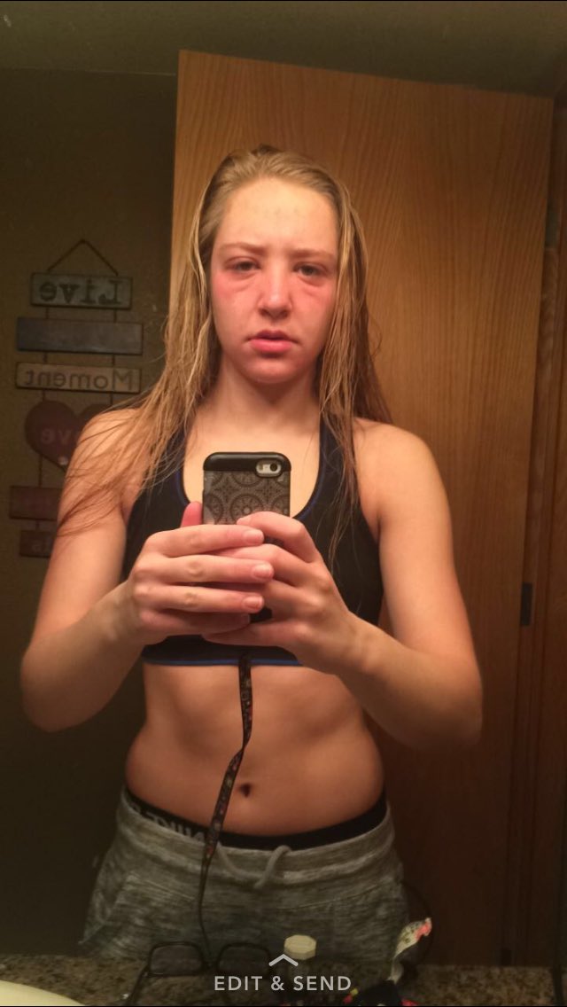 Pray for Emily's face pls