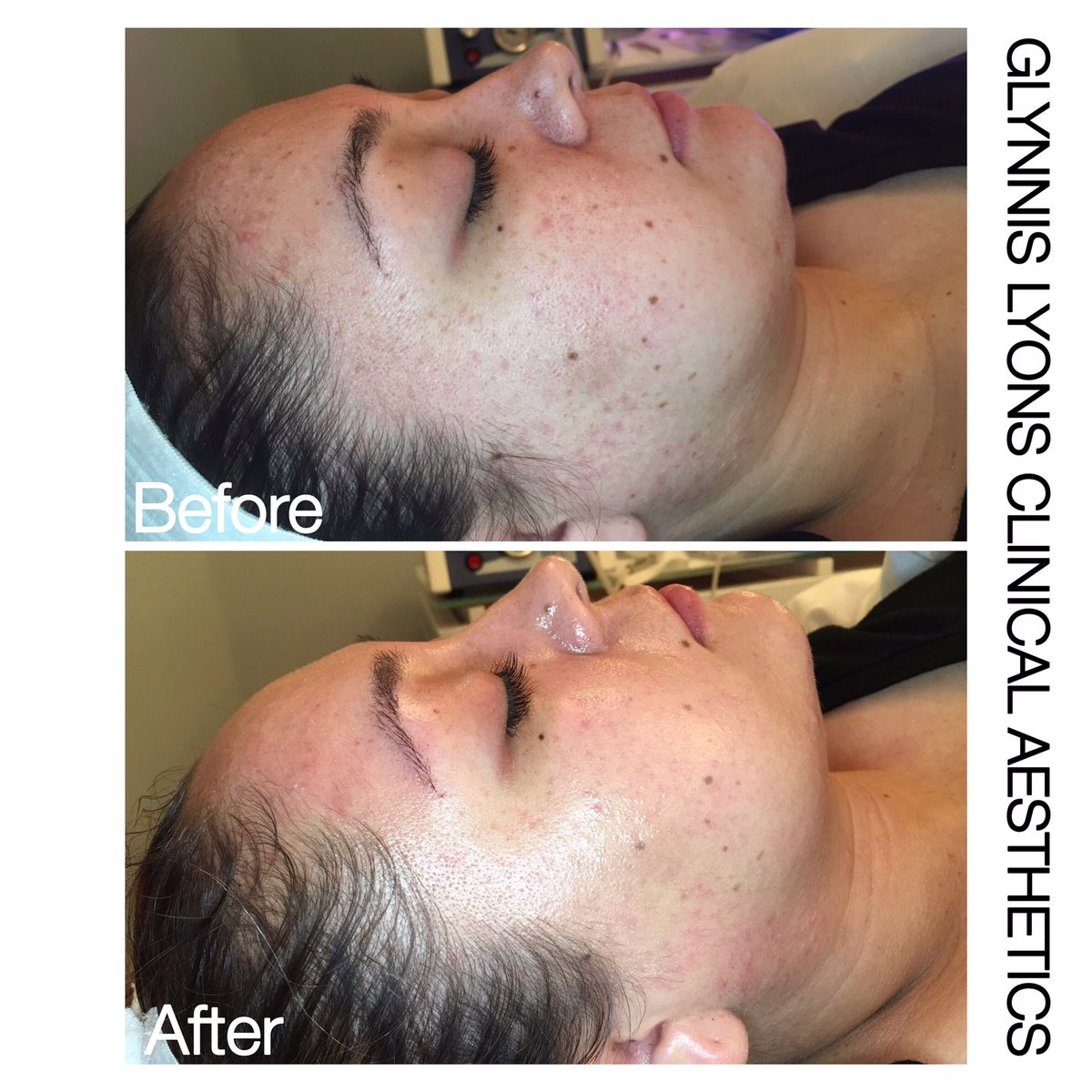 GlynnisLyons's tweet photo. #results #skintreatment #clinicalaesthetics #micropeel #microdermabrasion #facial #celluma #ledlighttherapy #led #skin https://t.co/DFN7OCqK0D