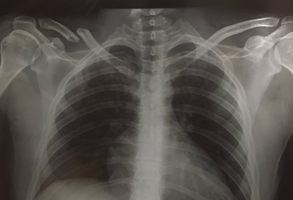 gabrirodrigo2's tweet image. Rotura de clavicula... no es como imaginaba empezar el año que más fuerte estaba siendo! Chapa y pintura y volveré aún más rápido que ahora!