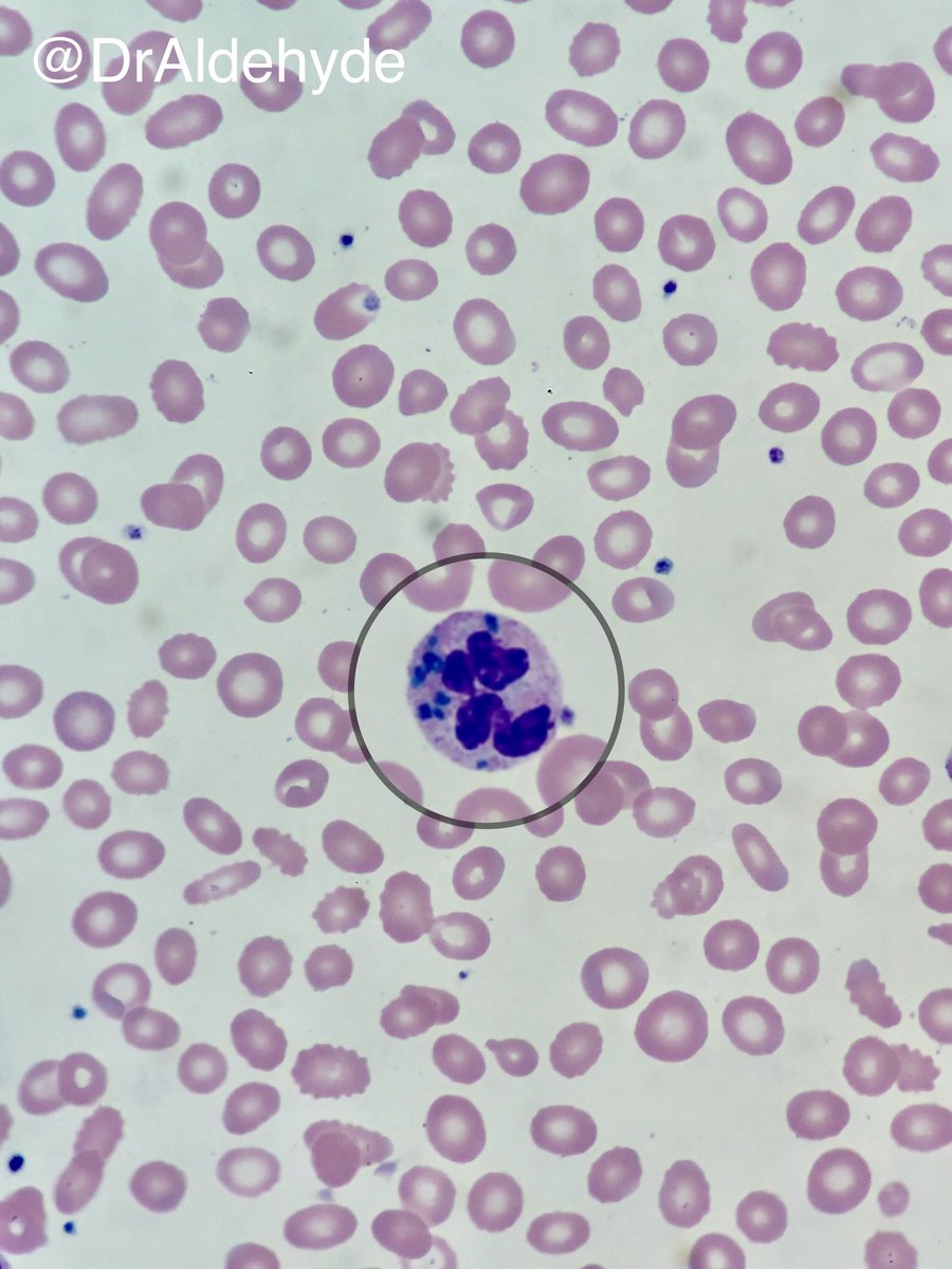 DrAldehyde's tweet photo. Could these green neutrophil inclusions really be a sign of impending death? Life is full of mysteries. #hemepath #hartfordpath #neutrophil https://t.co/aCsbgJeCE4