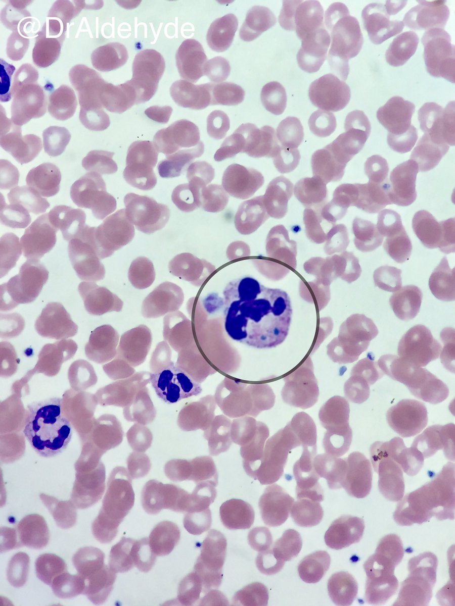 DrAldehyde's tweet photo. Could these green neutrophil inclusions really be a sign of impending death? Life is full of mysteries. #hemepath #hartfordpath #neutrophil https://t.co/aCsbgJeCE4
