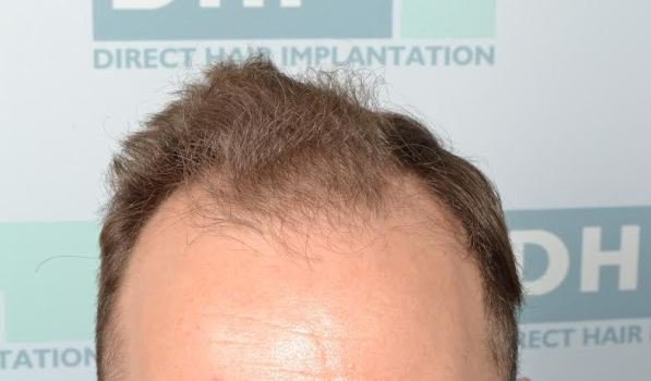 Hairtransplant_'s tweet photo. Patient timeline after DHI Hair Restoration https://t.co/q19RQEakJO #hairtransplant #hairloss #DHIMedical https://t.co/HT0DcopvAg