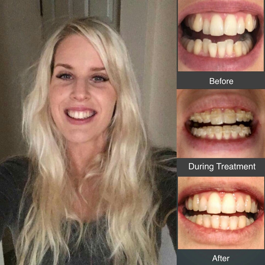 deansdentalcare's tweet photo. #quickstraightteeth #sohappy #deansdentalcare #drkakos #buildingconfience #greatresults https://t.co/aHQBV1pBkE