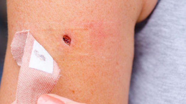 dermcast's tweet photo. From the #Dermcast Blog | Severely #Dysplastic Nevi: Should They Be Re-Excised to Prevent #Melanoma? | https://t.co/wTaMOTDZKQ | #DermPA https://t.co/hcVzRg0Clc