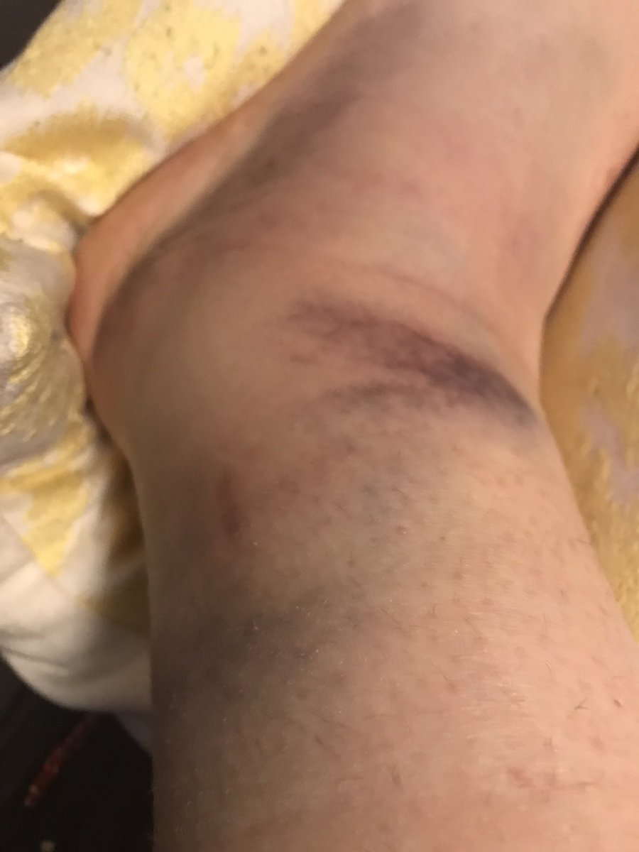 ElainePop44's tweet photo. I just want to be like Joel Berry II. He hurts his ankle!! We all hurt our ankles! ;) #UNC #UNCball https://t.co/1JF3DSSS3K