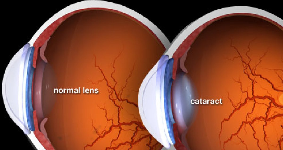 WebMD's tweet photo. Other eye conditions can cause blurry vision, too, but cataracts produce some distinctive signs. What to know: https://t.co/Cfv614CMhK https://t.co/2BZZVUK3ls