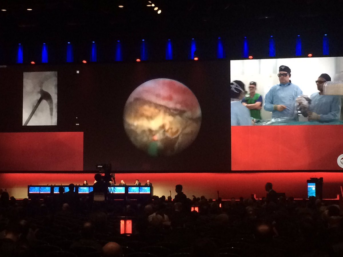Luke Gordon (@lukeurology) on Twitter photo Thank you to <a href="/lithohlr/">Hari Ratan</a> and <a href="/MattBultitude/">Matthew Bultitude</a> for a great demonstration of MIP-M #miniPCNL #eau17 #MIPmaster #eyerybodylovesstones Thank you to <a href="/lithohlr/">Hari Ratan</a> and <a href="/MattBultitude/">Matthew Bultitude</a> for a great demonstration of MIP-M #miniPCNL #eau17 #MIPmaster #eyerybodylovesstones