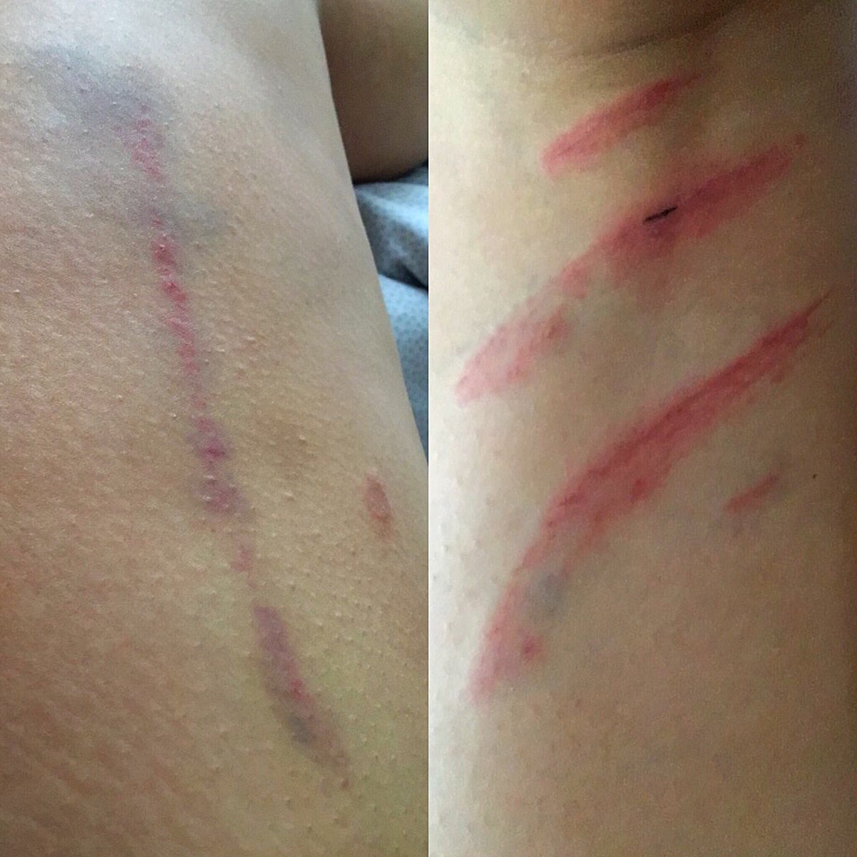 lucyyjonesx's tweet photo. When you're meant to be wearing a dress tonight and your legs look like this 🤔 #nevermind #thoughtwasthere #rugbyproblems #goblinshen 🏉💃🏽 https://t.co/hxVzz9NUsi