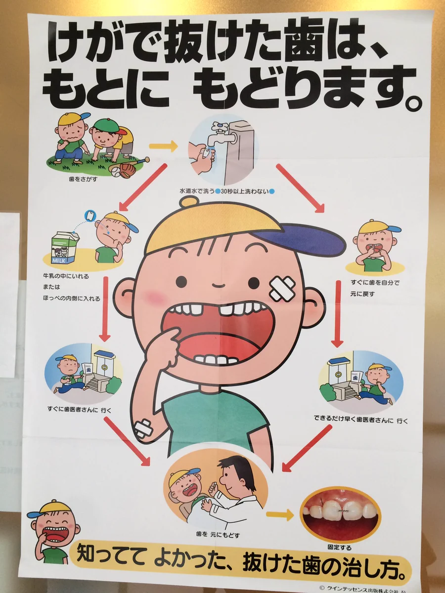 怪我が原因で抜けた歯はくっつく可能性も？！覚えておくといつか役立つかも！