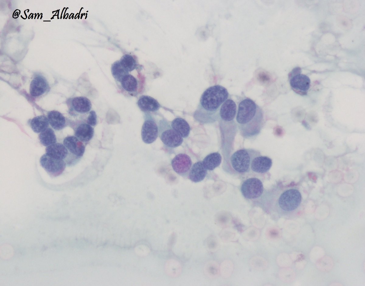 sam_albadri's tweet photo. 55F retroperitoneal Mx. Paraganglioma #FNA @SaudiCytopathol @JL_Sauter @CytopatholConf @edusqo @GeronimoJrLapac #cytopath #FNA #pathology https://t.co/iCK8WZvG4W