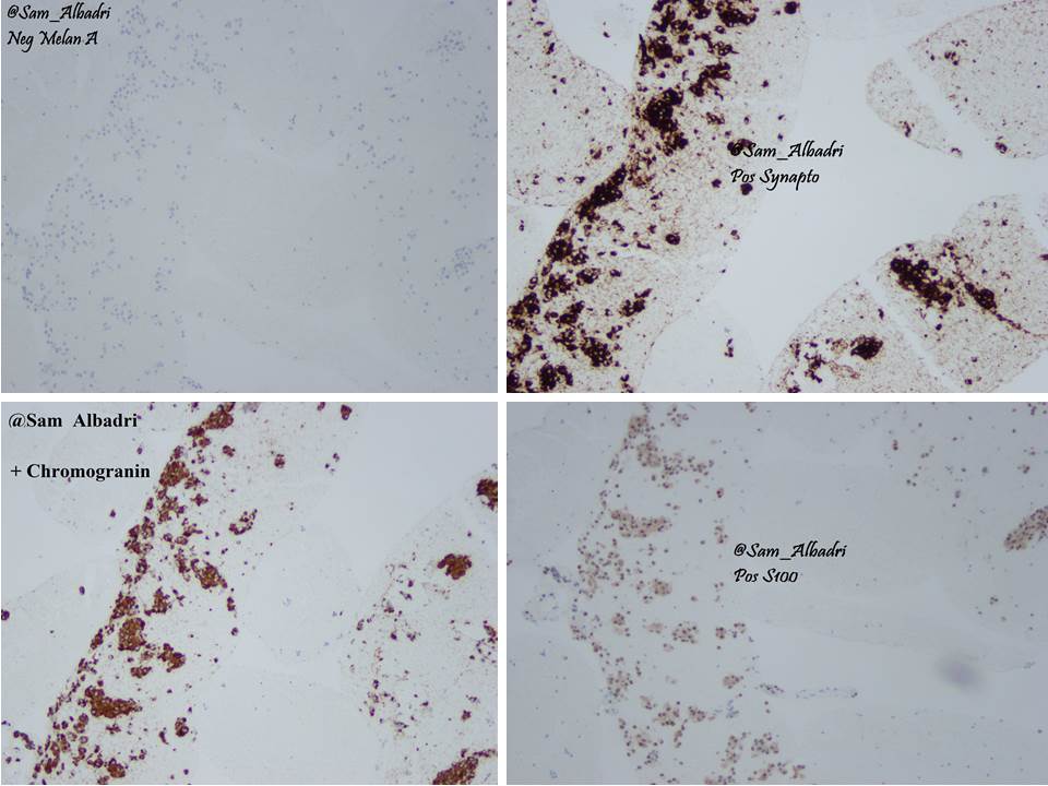 sam_albadri's tweet photo. 55F retroperitoneal Mx. Paraganglioma #FNA @SaudiCytopathol @JL_Sauter @CytopatholConf @edusqo @GeronimoJrLapac #cytopath #FNA #pathology https://t.co/iCK8WZvG4W