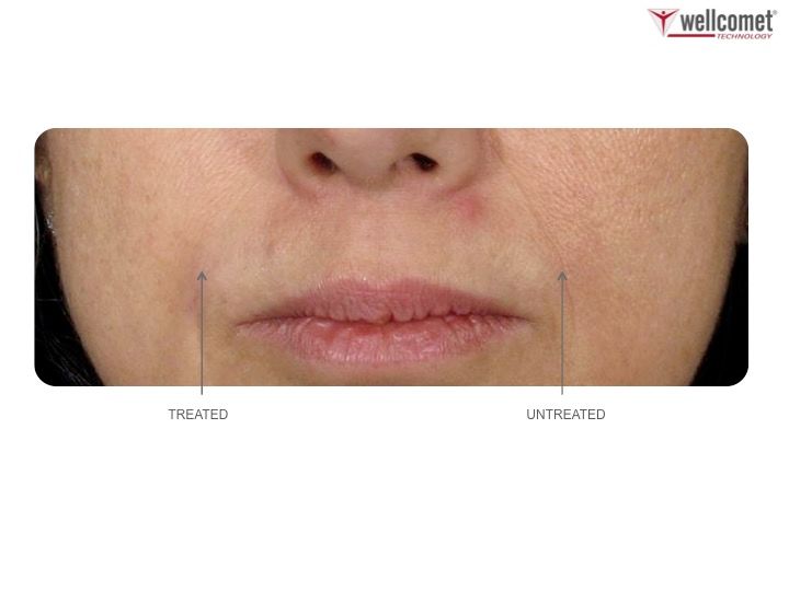 SkinovaMED's tweet photo. Bilder sagen mehr als Worte! Überzeuge dich von den tollen Ergebnissen der medizinischen #Ultraschalltherapie:  https://t.co/riGgvUNGzu https://t.co/AX8c0AzmAN