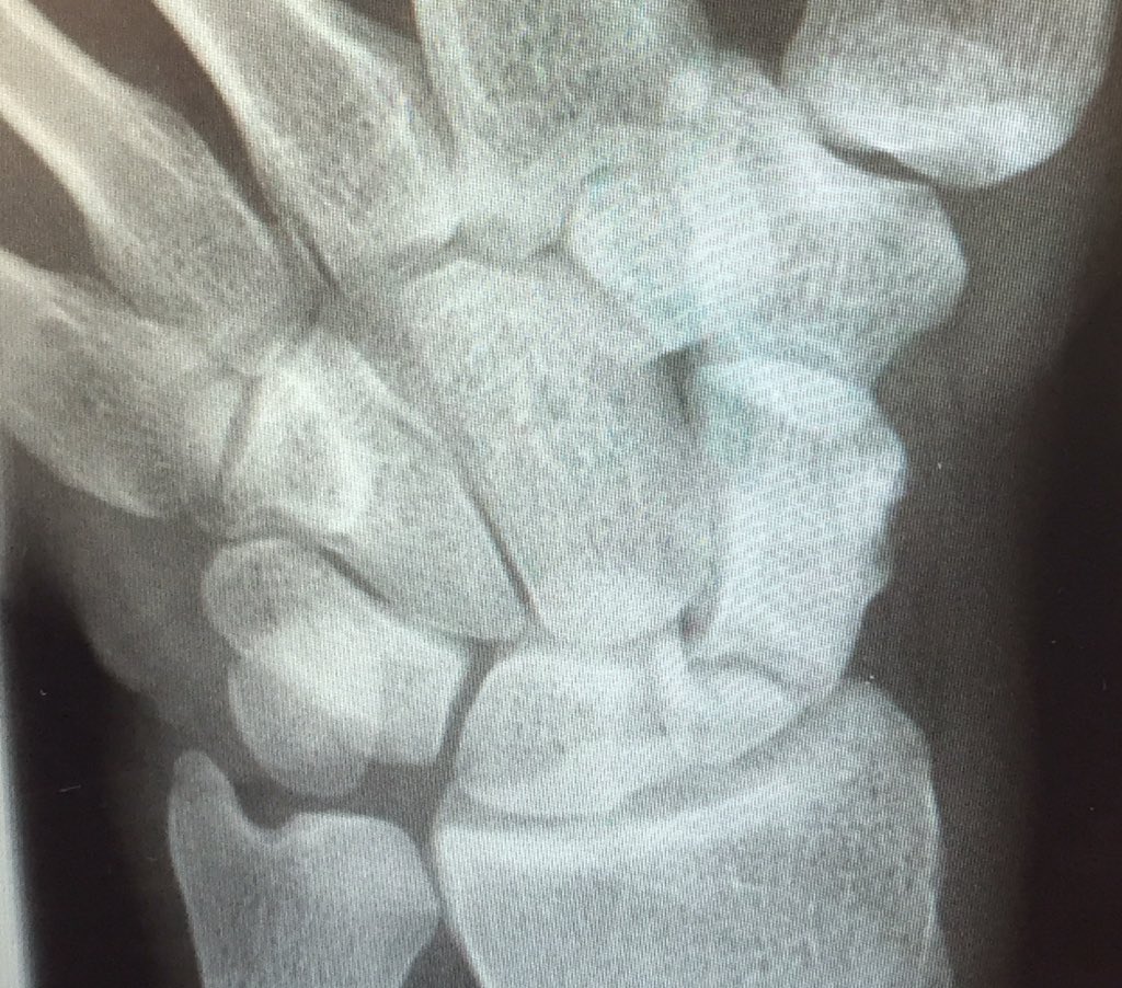 Ali Ghanem (@alimghanem) on Twitter photo Plastic and Orthoteams at Barts join force to treat non-union scaphoid fractures x2 today <a href="/PlasticsRLH/">Plastic Surgery RLH</a> <a href="/EmCareandTrauma/">RLH EC&T Division</a> <a href="/NHSBartsHealth/">Barts Health</a> Plastic and Orthoteams at Barts join force to treat non-union scaphoid fractures x2 today <a href="/PlasticsRLH/">Plastic Surgery RLH</a> <a href="/EmCareandTrauma/">RLH EC&T Division</a> <a href="/NHSBartsHealth/">Barts Health</a>
