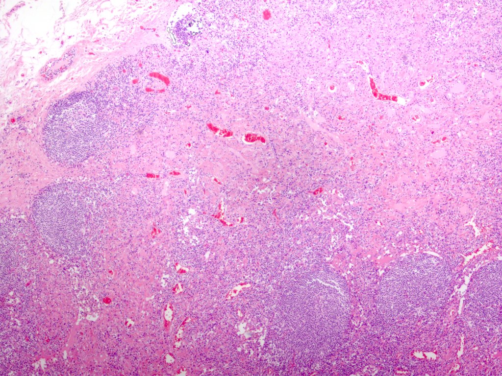 ARP_Press's tweet photo. Vascular transformation of lymph node sinuses, a reactive vascular proliferation that may mimic Kaposi sarcoma and bacillary angiomatosis. https://t.co/IFe1jOeSHj