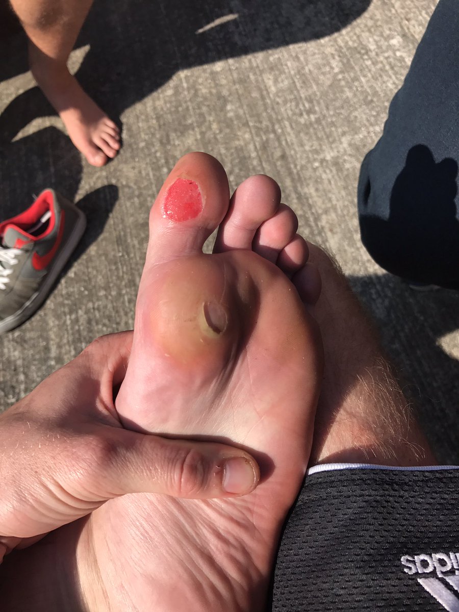Lewisgy01's tweet photo. @GuvnaGavin same #blisters #football https://t.co/bvJafeGsRA