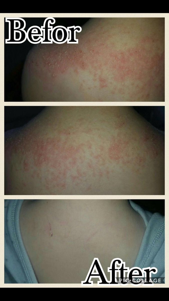 JPD2503's tweet photo. @Neutral_Skin these are the results for anyone else who's struggling with eczema,Amazed by the results after only a few wks, amazing product https://t.co/FCu0UGeb1f