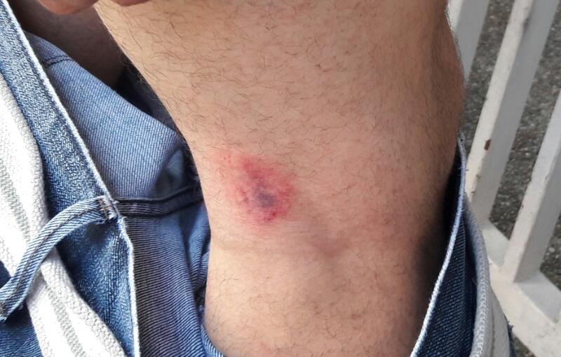 ipysvenezuela's tweet photo. #AvanceIPYSve Así quedó la pierna de @Luisgonzalopr, reportero de @CaraotaDigital, tras impacto de bomba lacrimógena disparada por un PNB https://t.co/ep8fIZLch1
