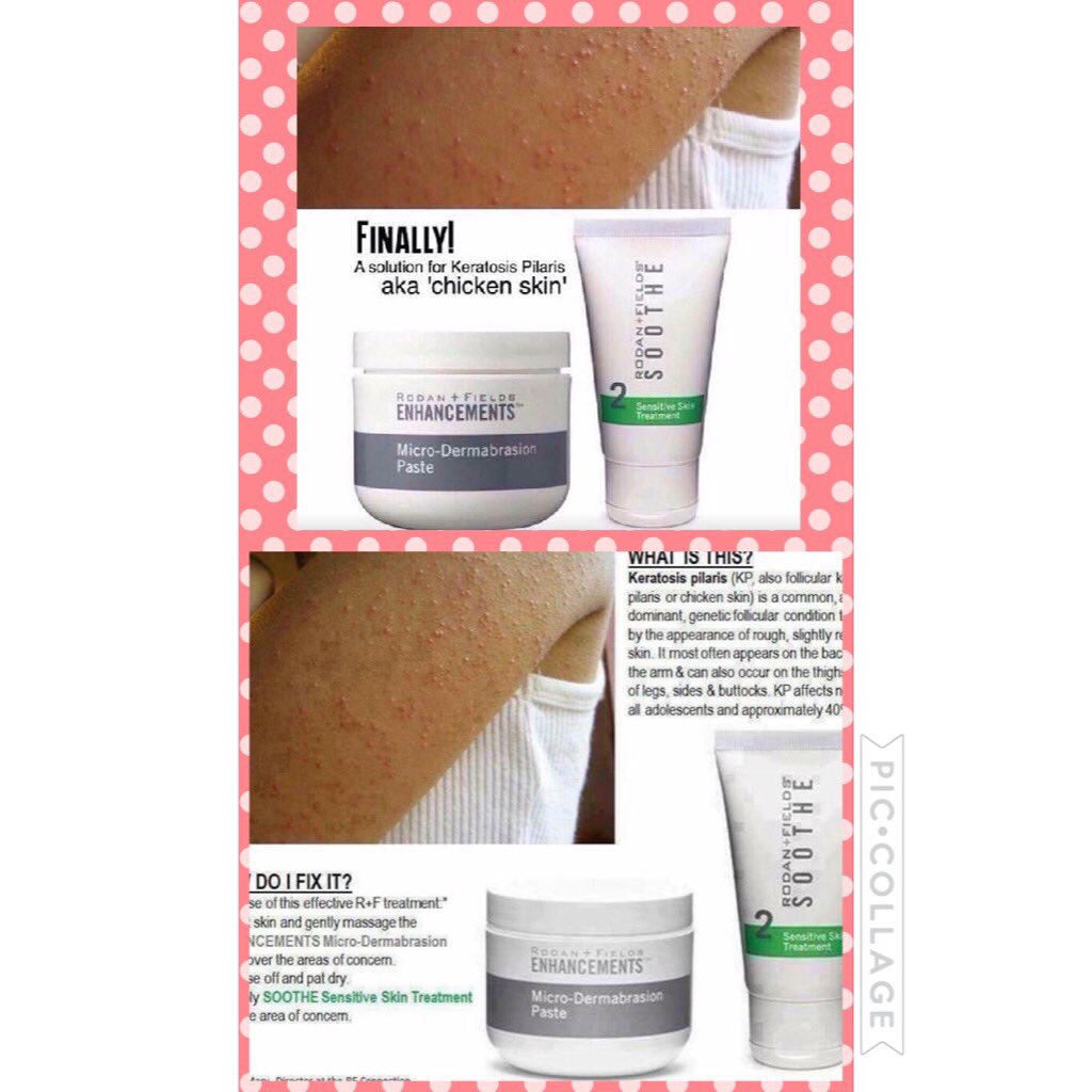 CareyTochterman's tweet photo. Get rid of your "chicken skin" to show off your smooth skin this summer! Let's talk how! #nochickenskin #smoothsummer #sootheandmdpaste https://t.co/by8putzxO0