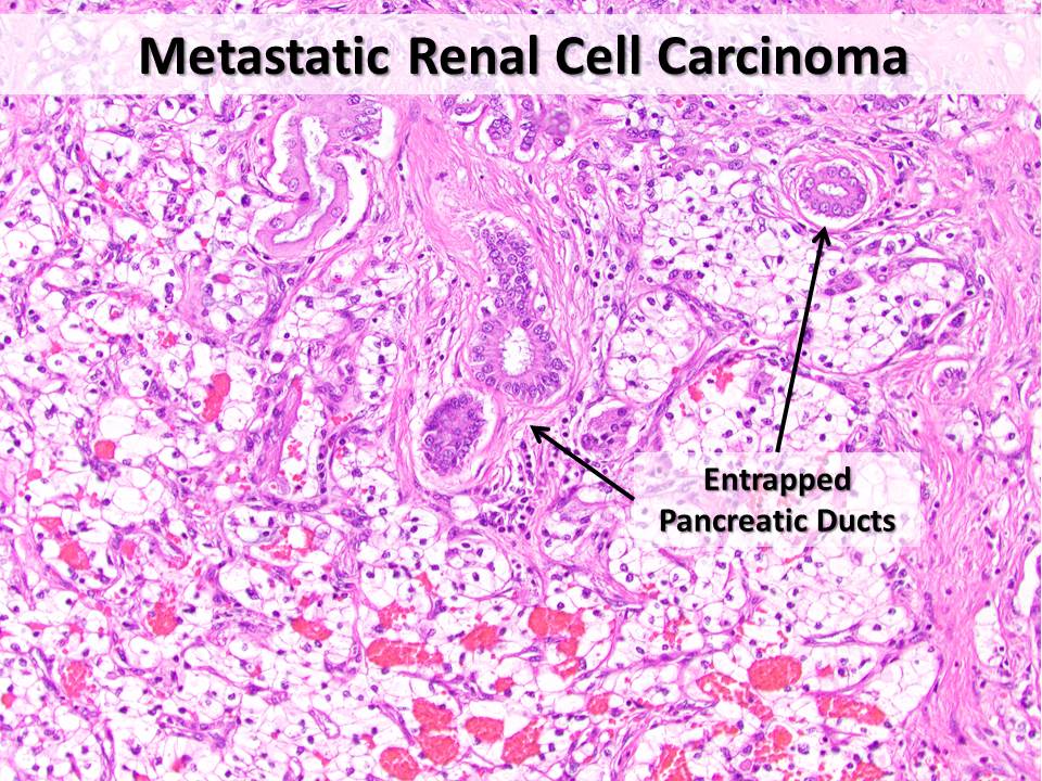 PancPathologist's tweet photo. Renal cell carcinoma is one of the most common resectable metastases to the #Pancreas #GIPath #Pathology https://t.co/mUXMRPcPKm