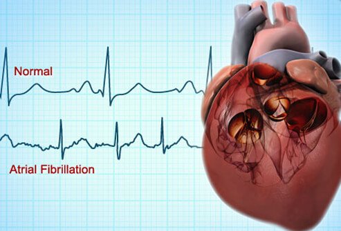 Learning: Atrial Fibrillation some revision... - abdn-em.co.uk/?p=769
