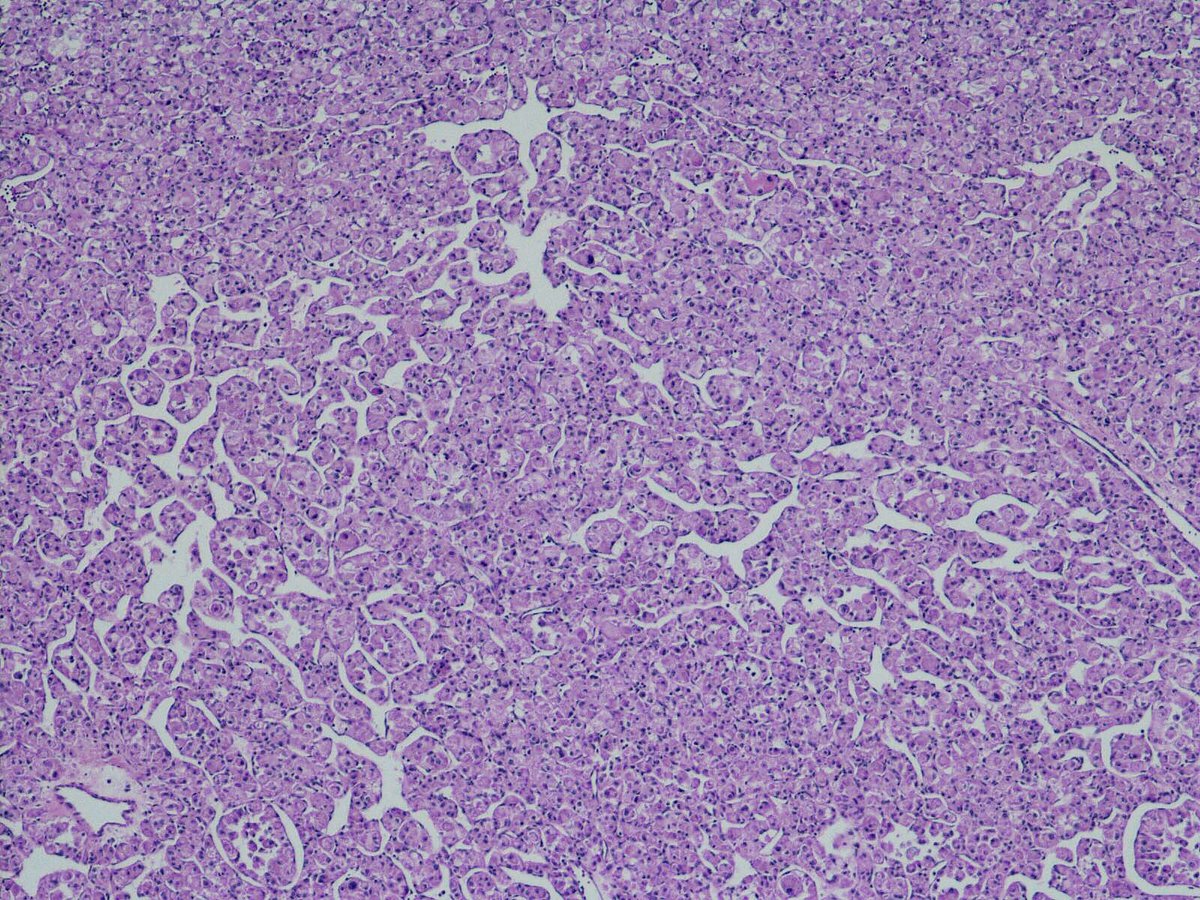 Abubaker Elshaikh Neck Mass Alveolar Soft Part Sarcoma Positive Tfe3 Aspscr1 Gene Rearrangement Cytology Surgpath