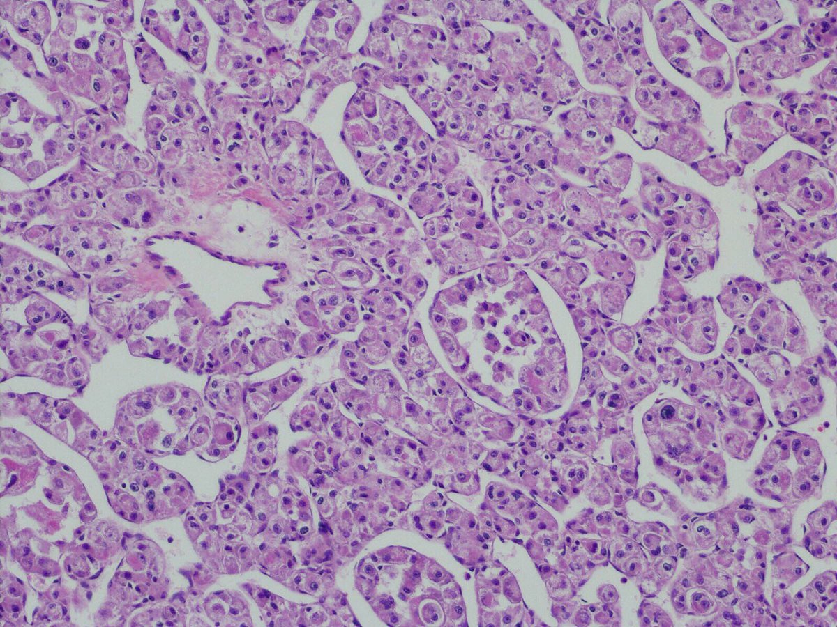 Abubaker Elshaikh Neck Mass Alveolar Soft Part Sarcoma Positive Tfe3 Aspscr1 Gene Rearrangement Cytology Surgpath