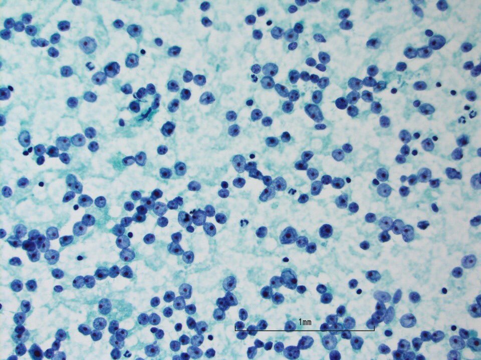 Abubaker Elshaikh Neck Mass Alveolar Soft Part Sarcoma Positive Tfe3 Aspscr1 Gene Rearrangement Cytology Surgpath