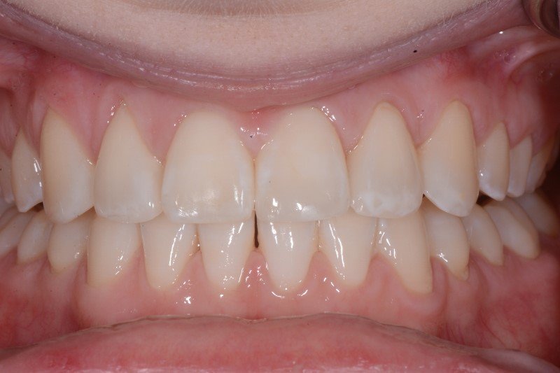 CheshireDentist's tweet photo. WOW Wednesday! Non invasive smile makeover, by Steve Lomas #SimplySmile #clearbrackets #venuspearl thanks to @WiredOrtho @BoutiqueWhiten https://t.co/huWqzGiHkd