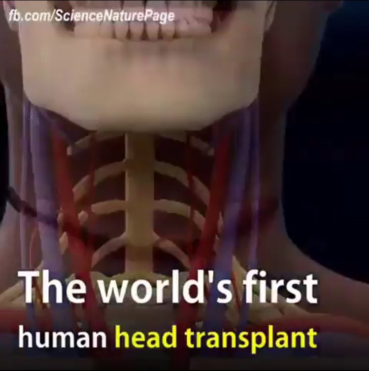 DrEmmaFrans's tweet photo. Huvudtransplantation - för dig som tycker att Macchiarinis plaststrupar ger för goda överlevnadschanser https://t.co/eQe5oEDwS8