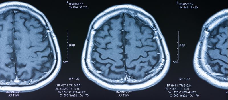 AutoimmuneList's tweet image. Patients with #autoimmune diseases appear to have an increased risk of developing dementia, according to a study buff.ly/2ojwnLh