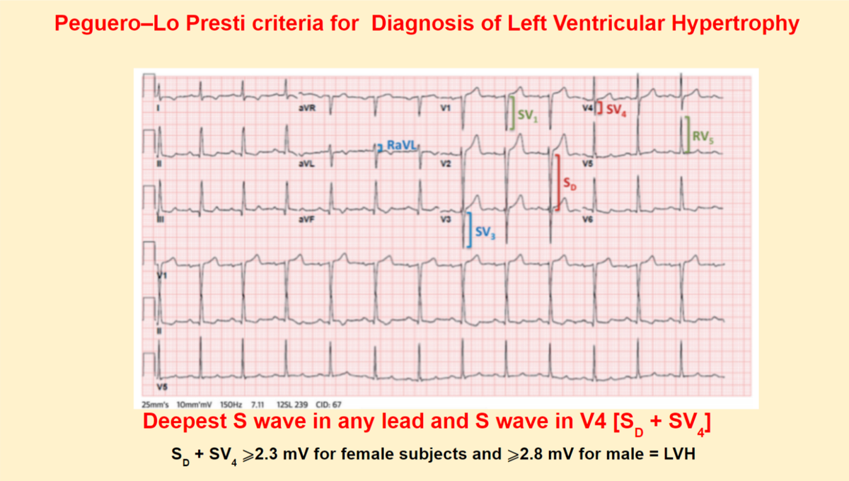 ugurkucuk's tweet image. New Electrocardiographic Criteria for the Diagnosis of Left Ventricular Hypertrophy. 62% sensitivity(Cornell 35%). Check it out #FOAMed #ECG