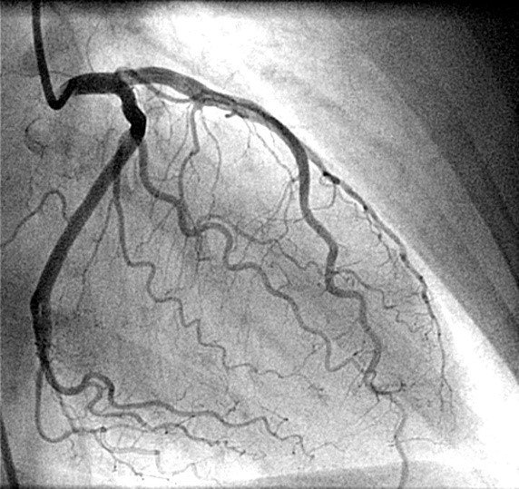 The growing adoption of #RadialAccess for #CardiacCatheterization procedures has not compromised #clinical outcomes. qoo.ly/efzuk