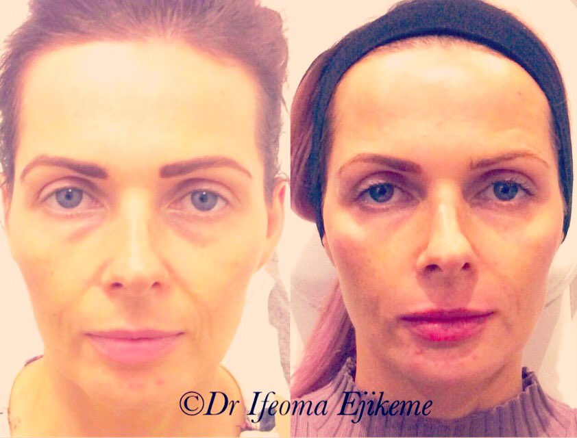 DrEjikeme's tweet image. Don&apos;t look at lines or wrinkles instead consider the face a harmonious unit #beforeandafter #DrEjikeme #dermalfiller