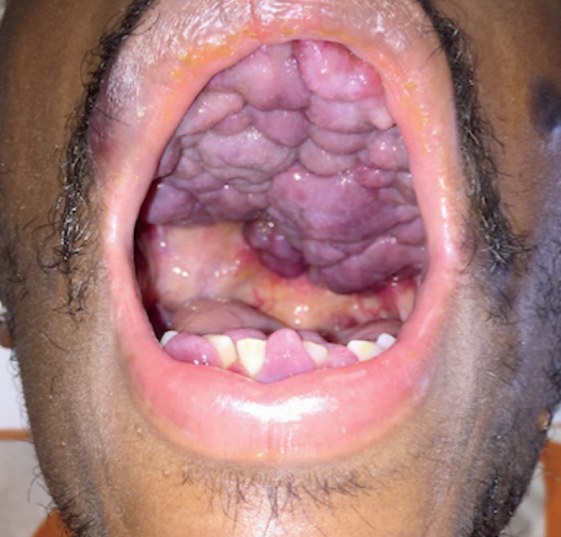 Nejm Images In Clinical Medicine Kaposi S Sarcoma Of The Oral Cavity T Co Hgouqcpqw5
