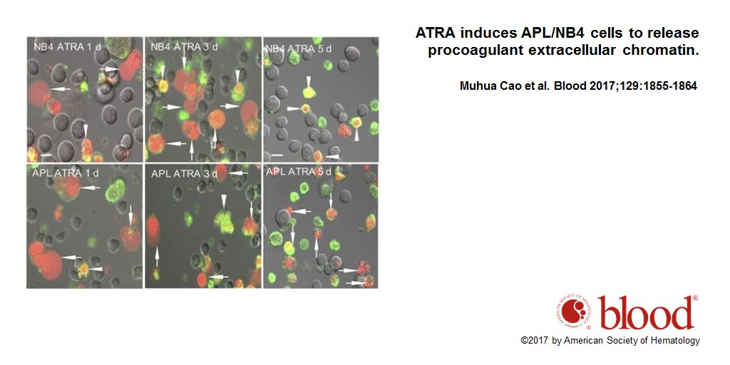 BloodPortfolio's tweet photo. Novel mechanism of coagulopathy in acute promyelocytic #leukemia https://t.co/Xy0PX9daH2 #thrombosis https://t.co/RMy5uWRzdt