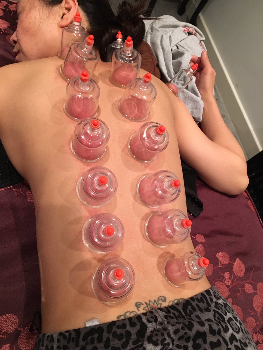 MassageNcl's tweet photo. Cupping massage https://t.co/gyocvSuHQ3