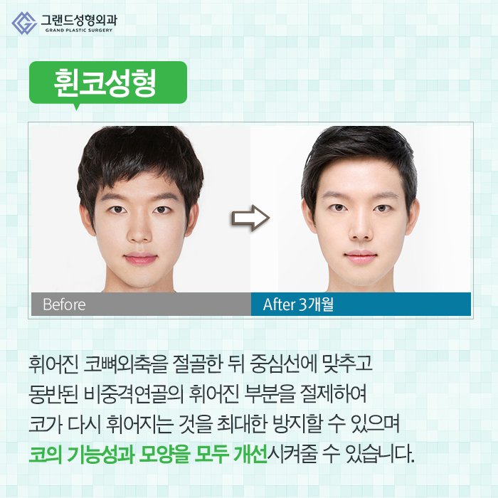 Grand_PS's tweet image. 코는 얼굴의 중심인만큼 많은 사람들이 이미지 변신을 생각할 때 고려하게 되는 코성형! 오똑한 모양만을 추구하는 것보다 내 얼굴과 어울리고 적당한 각도와 비율을 고려해야 예쁜 모양을 완성할 수 있다는 사실♥#그랜드성형외과 #코성형 #코수술 #beauty