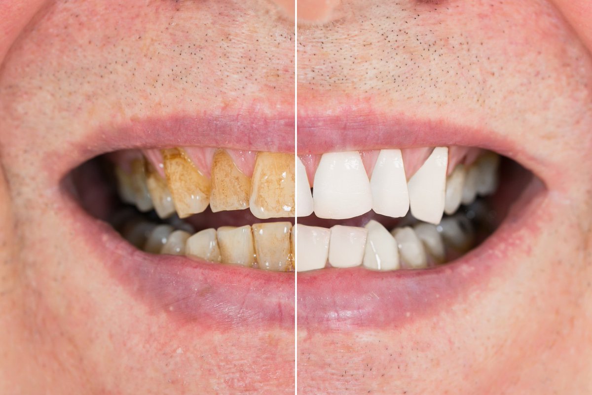 JohnMillerDent's tweet photo. Scaling eliminates the hard calculus that forms on the teeth and which cannot be removed by brushing alone. https://t.co/EQetAKv1S7 https://t.co/bKBHa8QKTF