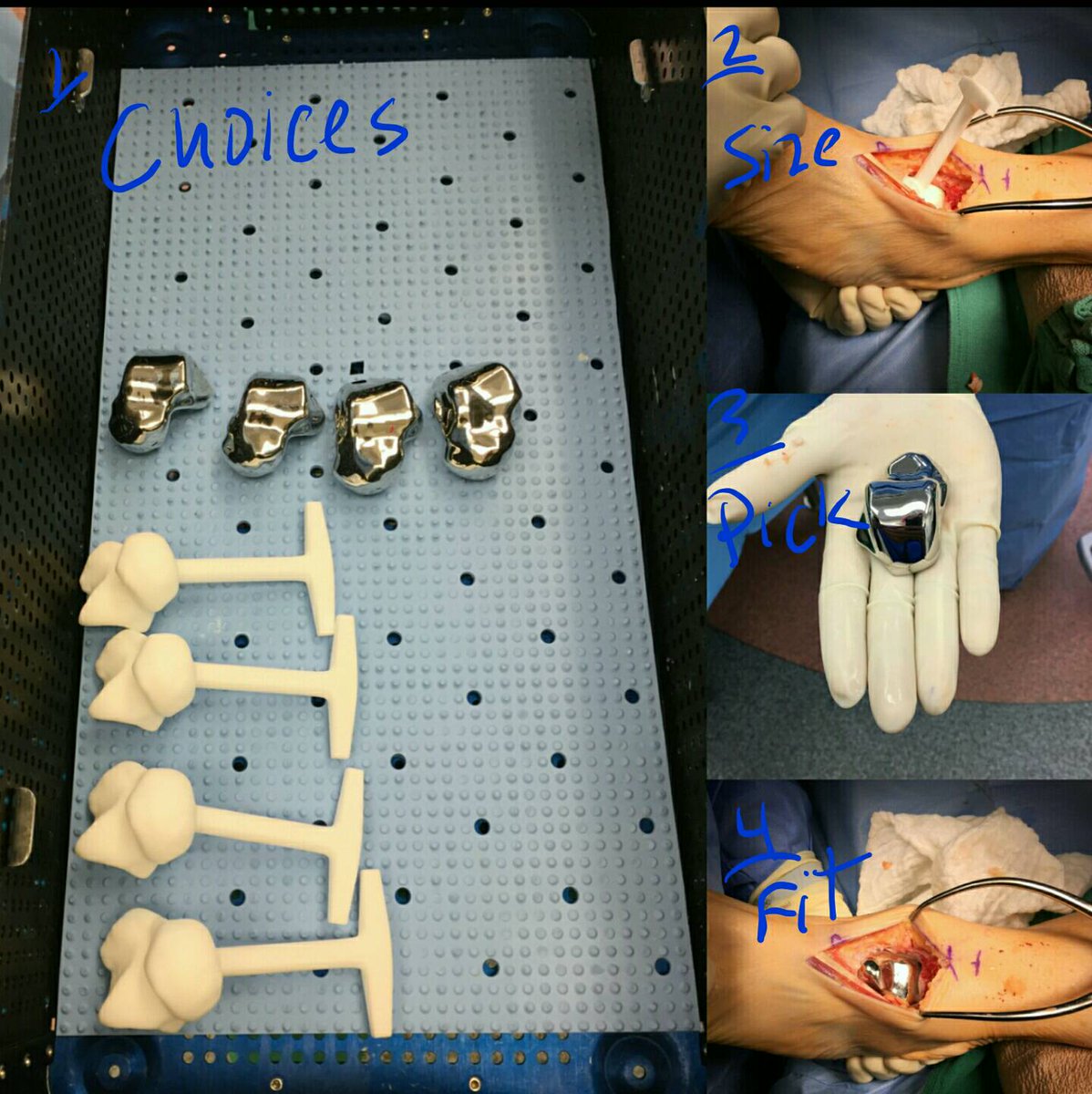 seleneparekhmd's tweet photo. #3Dprinting can replace bones 2 prevent jt fusions in special cases. Allows return to work & keep motion #TechDoc #TotalTalus #AVNTalus https://t.co/MRP1MxioB2