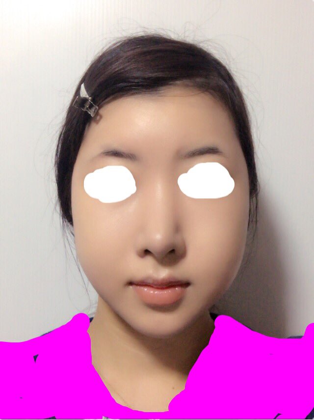 ぴか 術後2ヶ月 正面と横顔のbefore Afterです 顎とエラ部分は皮膚と骨がぴったりくっついてる感じがありますが その間の部分にもたつきが残っています 腫れなのか弛みなのか 頬肉が多すぎるのかわかりません もうちょっとスッキリして欲しいので ぴか 術後2ヶ月 正面と横顔のbefore Afterです 顎とエラ部分は皮膚と骨がぴったりくっついてる感じがありますが その間の部分にもたつきが残っています 腫れなのか弛みなのか 頬肉が多すぎるのかわかりません もうちょっとスッキリして欲しいので