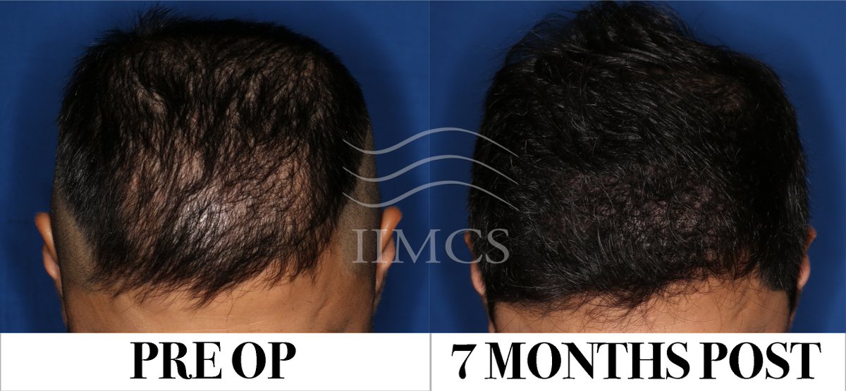 IrvineInstitute's tweet photo. #Grayhair is a #blessing, ask any #bald man. #FUE #beforeandafter #results #hairloss #folliclefriday #ochairrestoration #FlashbackFriday https://t.co/KxTYNotXvH