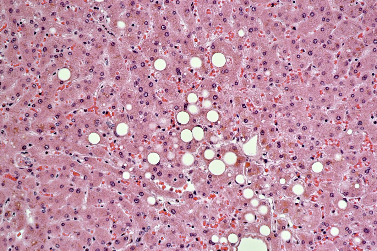 laballyceo's tweet image. #LabAlly is attending the #NASH summit in Boston nash-summit.com. We have normal and diseased liver samples immediately available.