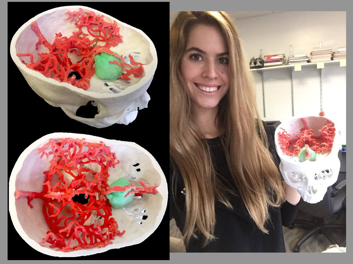 knicol15's tweet photo. Our best #3dprint yet! Vasculature, tumor & skull - beautiful team effort by @MountSinaiNeuro @holly_mkey @anthonycosta Come see us #AANS17 https://t.co/tb9N7ludK3