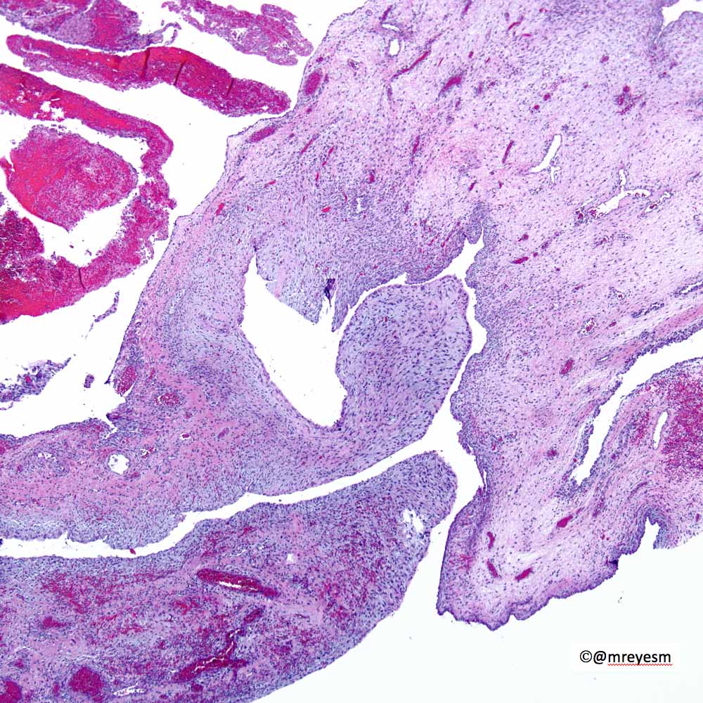#PediPath #pulmpath 4 YO. Differential diagnosis? IHC you would suggest? #pathboards
