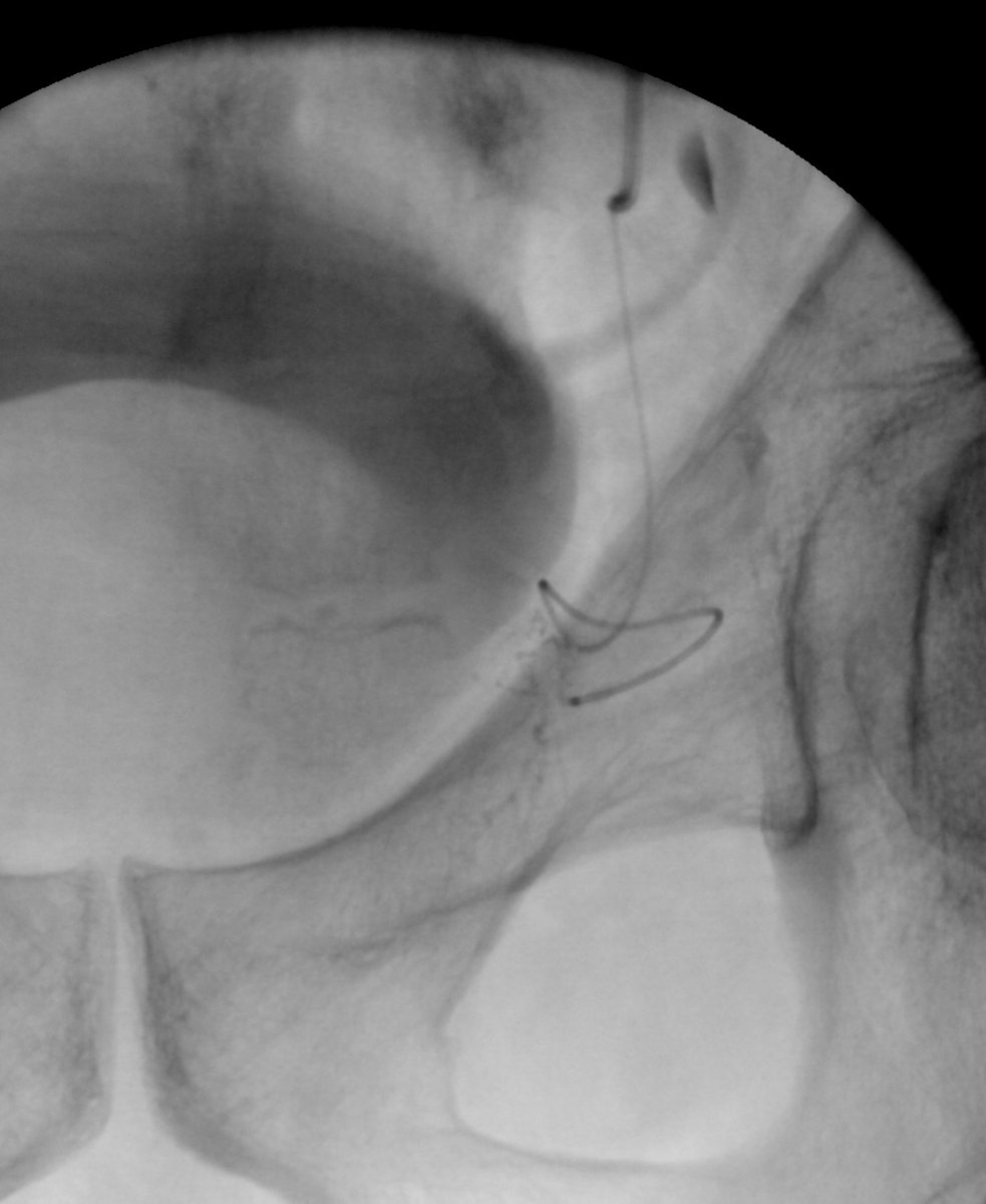 @AriIsaacsonMD @bonesz @UMiamiIR @SaherSabri_UVA @Stanford_IR Too Easy @AriIsaacsonMD? No problem for the 2F MC. What do they say? #justgetintherightvessel before #pae