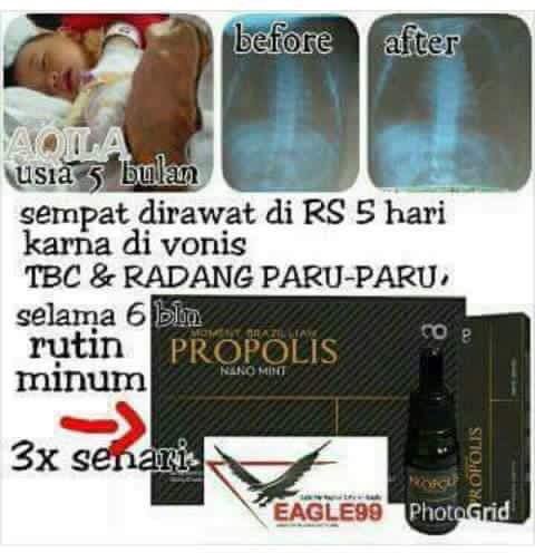 anisa2eka's tweet photo. Alhamdulilah....Ada Moment Propolis.
TBC dan Radang Parunya membaik pemirsah.More info lebih lanjut please pm me.WA+6594529922
BB:5BF9796F https://t.co/gtvnuVmqtJ