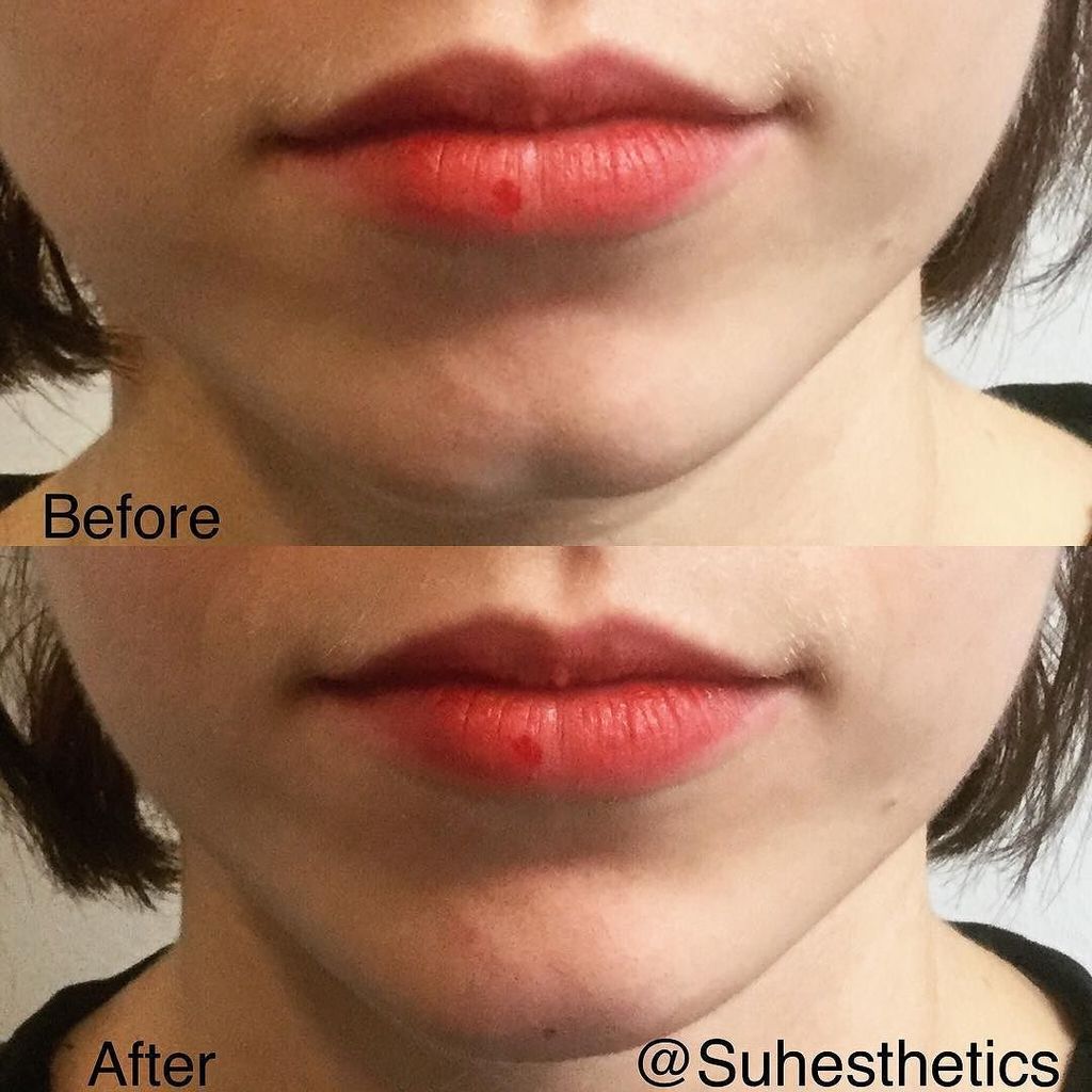 Cleft Chin Before And After