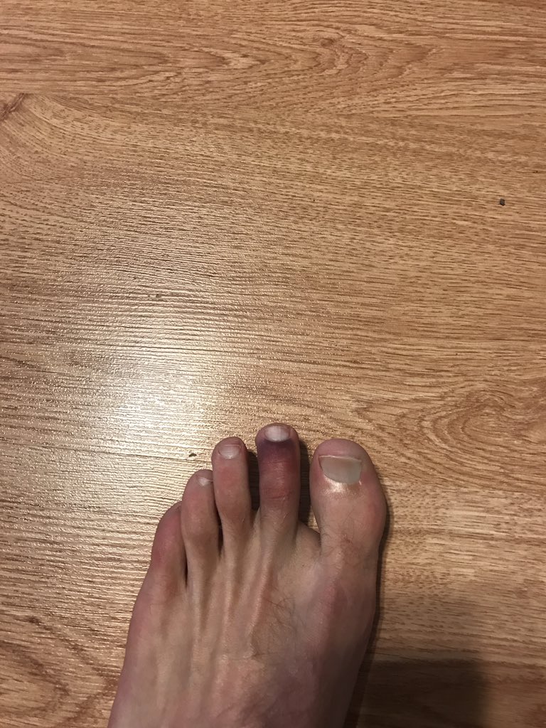 Broke my toe 😞